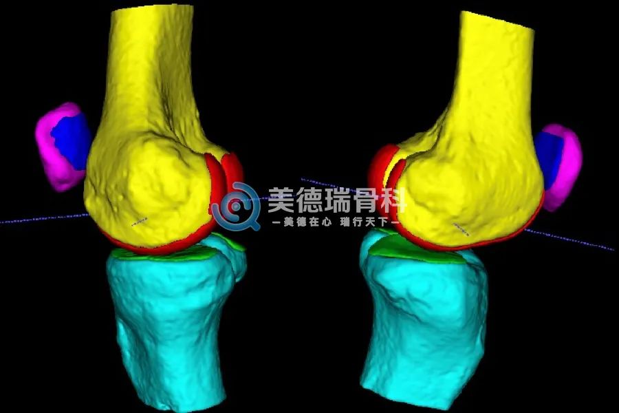 基于膝关节MRI人工智能识别的六类分割结果