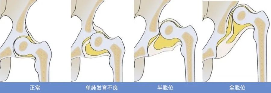 先天性髋关节发育不良