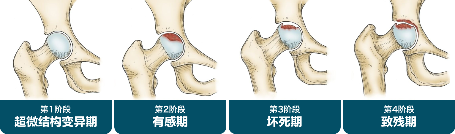 股骨头坏死