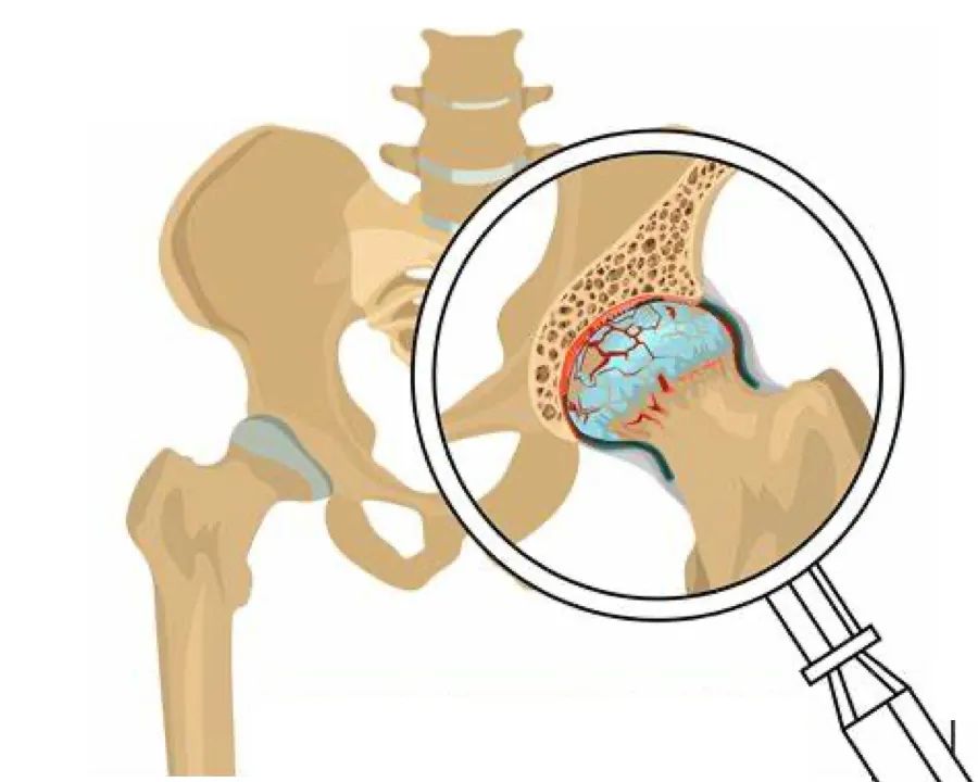 髋关节骨性关节炎