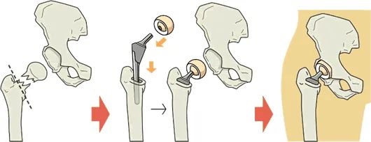 人工髋关节置换手术