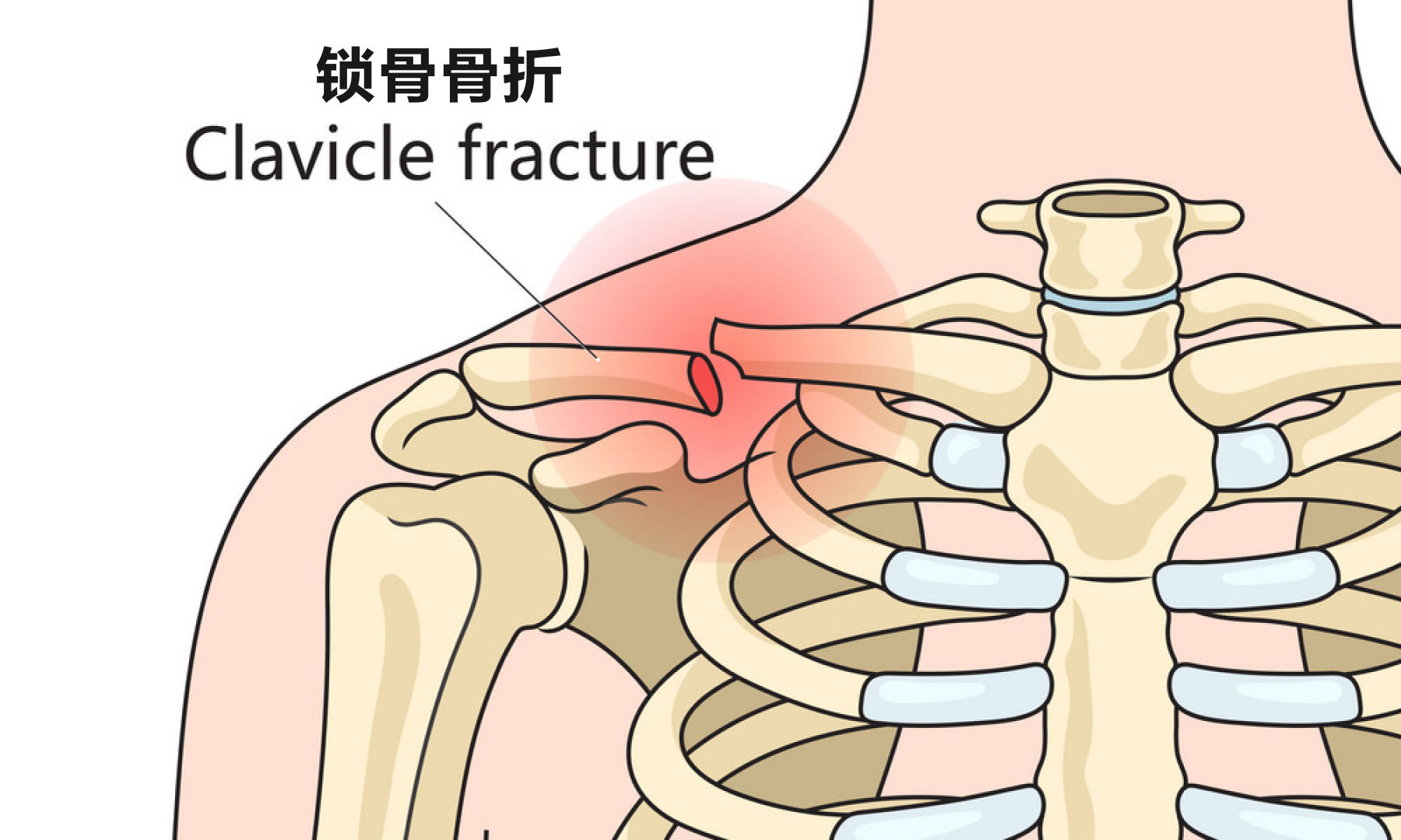 锁骨骨折